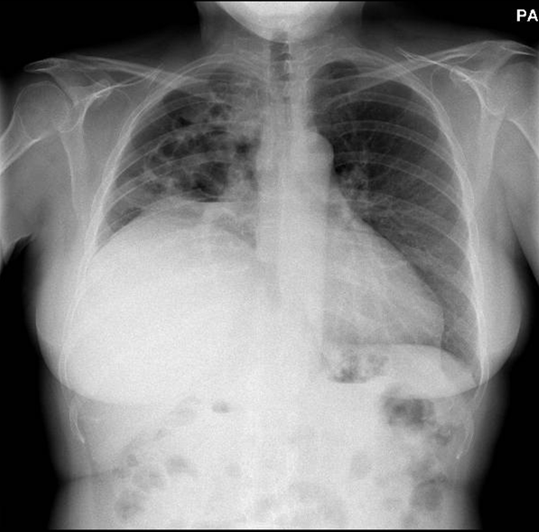 Linfoma de célula grande B pulmonar, después del tratamiento